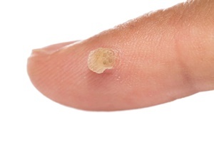 Μια κονδυλωμάτων είναι μια ασθένεια του δέρματος που αποτελεσματικά καταπολεμά Skincell Pro